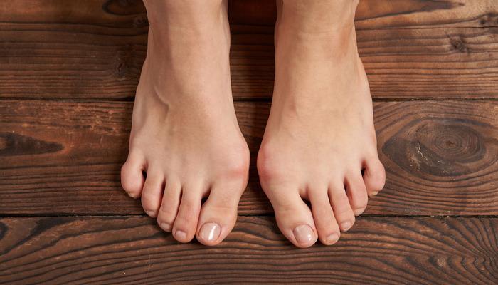 Halluks valgus nedir? Halluks valgus’u ameliyatsız düzeltmek mümkün mü? Halluks valgus tedavisi