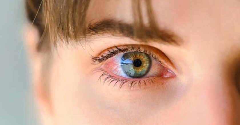 Borforit nedir (kirpiklerin dibinin iltihabı)?